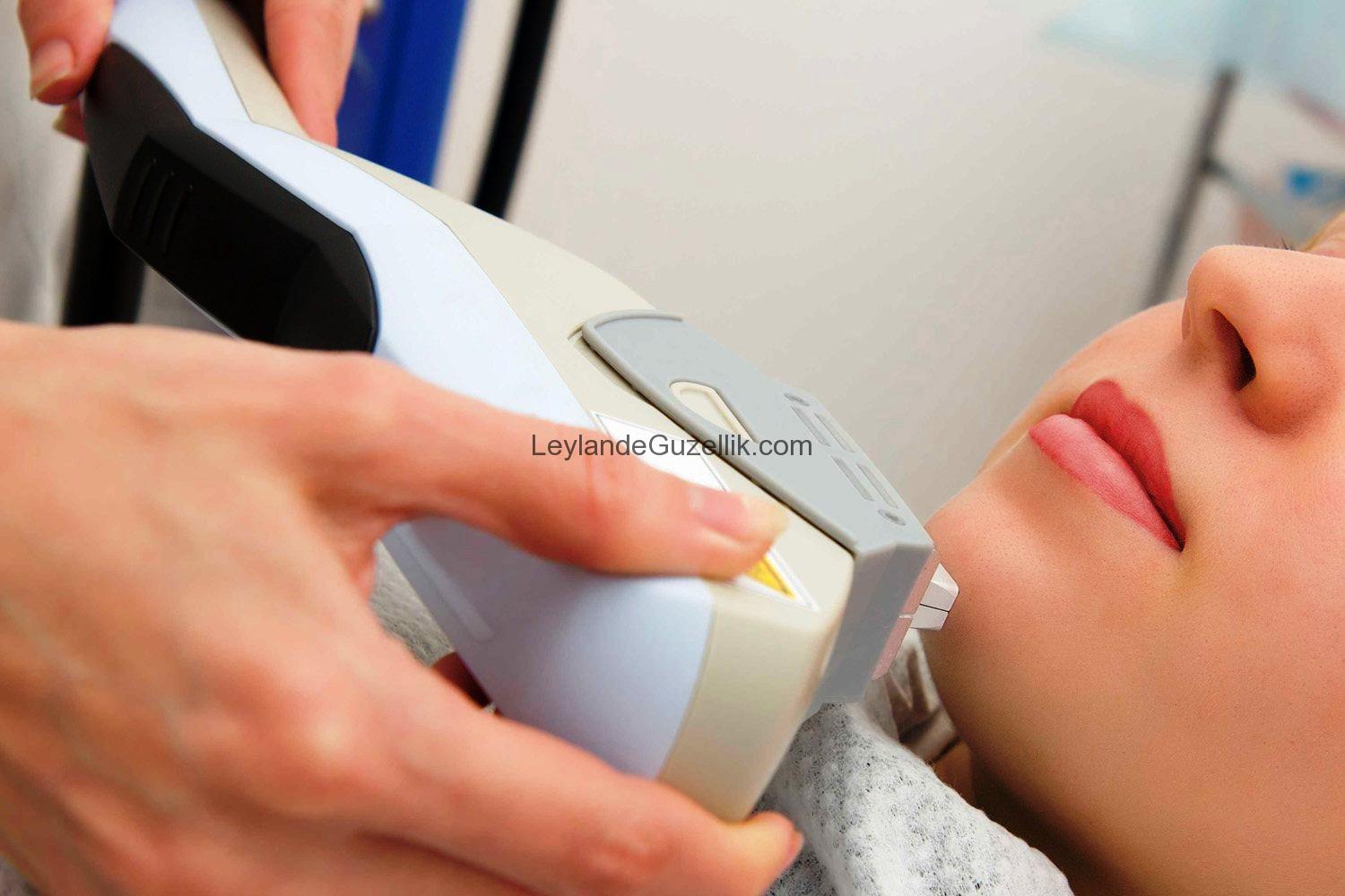 Lazer Epilasyon Sıkça Sorulan Sorular