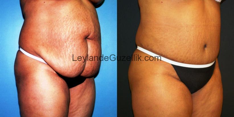 Liposuction Bölgesel Yağ Aldırma Liposakşın 2017 Fiyatları