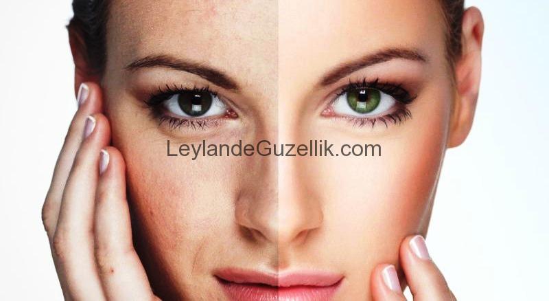 Leylande Güzellik’te Dermapen Uygulaması – Yüz Cilt Kusurlarına Son!