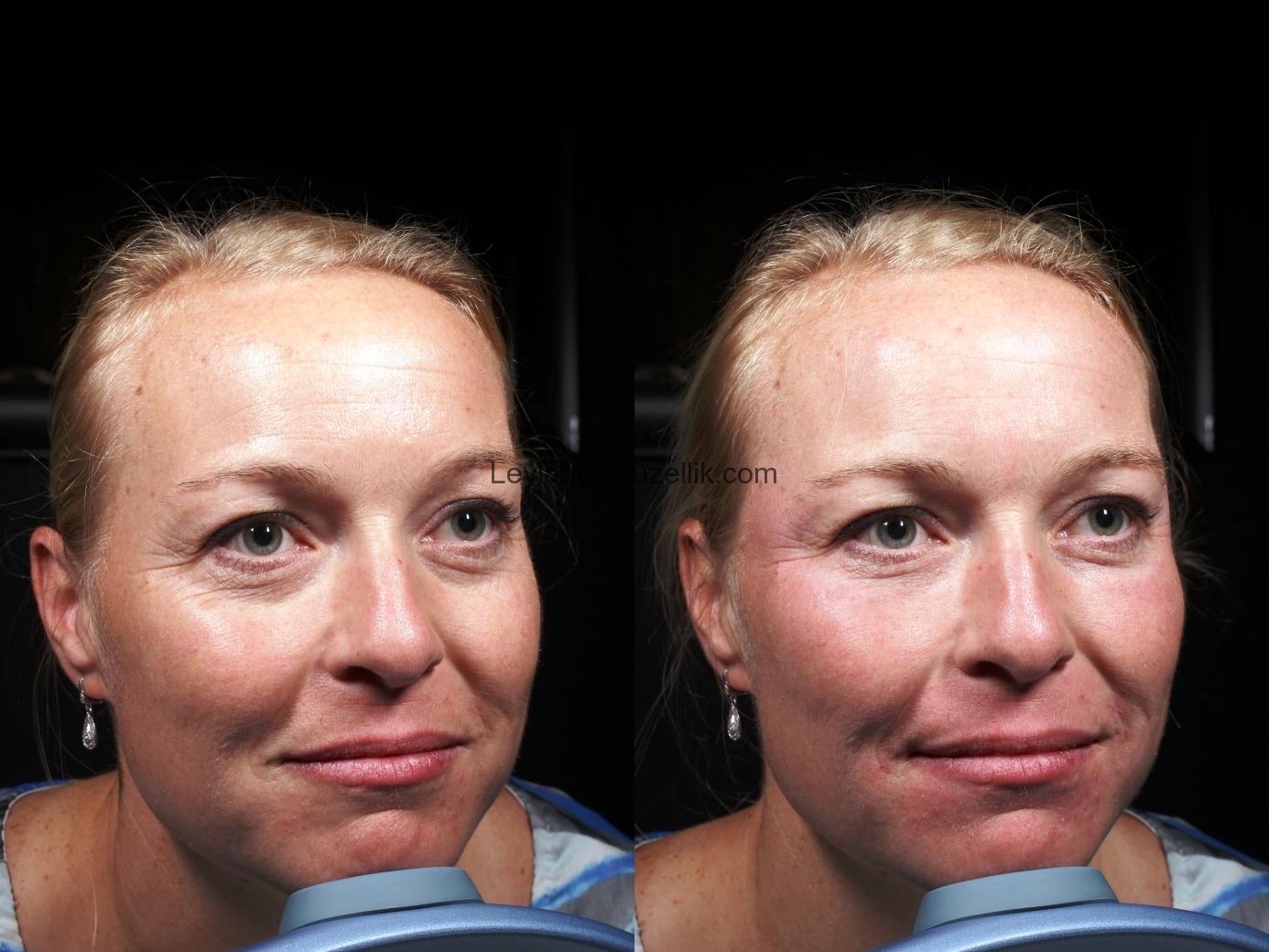 Dermapen ile Cilt Uygulamaları ve Gençleştirme Fiyatları