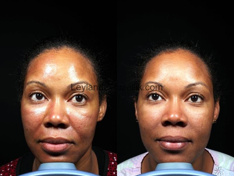 Dermapen Mikro İğmeleme Cilt Uygulamasi Fiyatları Maltepe